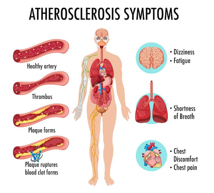 ارتفاع الكوليسترول اسبابه وطرق الوقاية 4 ارتفاع الكوليسترول اسبابه وطرق الوقاية